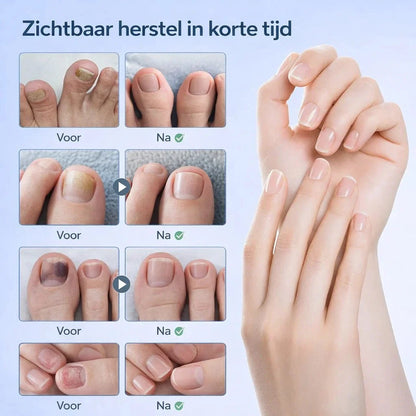 NailRestore – Herstel je nagels zichtbaar van binnenuit